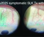 lissamine green staining on the superior bulbar conjunctiva before BTX