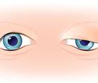 Ocular Ptosis and Its Differential Diagnosis