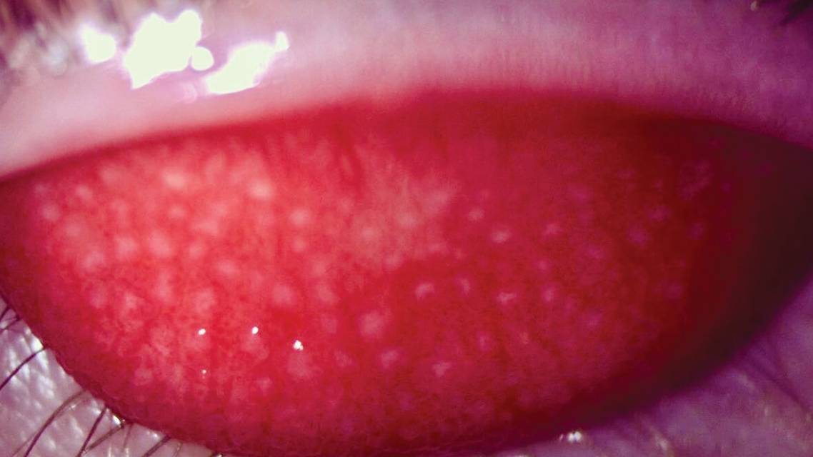 Giant Papillary Conjunctivitis Diagnostic Pearls