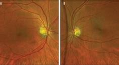 retina image