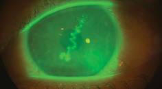 Herpes Knows No Borders