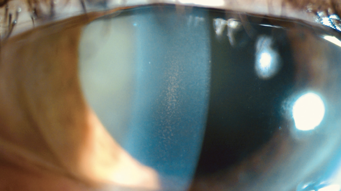 Pigmentary Dispersion Syndrome and Pigmentary Glaucoma