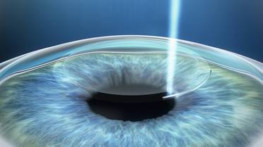 Zeiss Marks Milestone With More Than 5 Million Eyes Treated With SMILE image