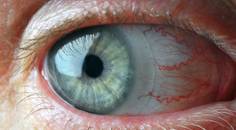 Dry Eye and the Contact Lens Wearer