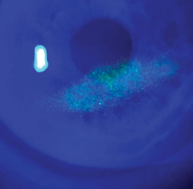 neurotrophic keratitis