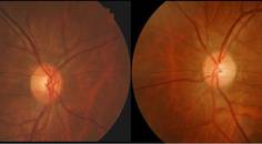 Ocular Effects of Pituitary Tumor