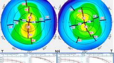 Collaborative Case 011 Treating Irregular Astigmatism After Laser Vision Correction