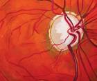 Forward Progress in Glaucoma Management