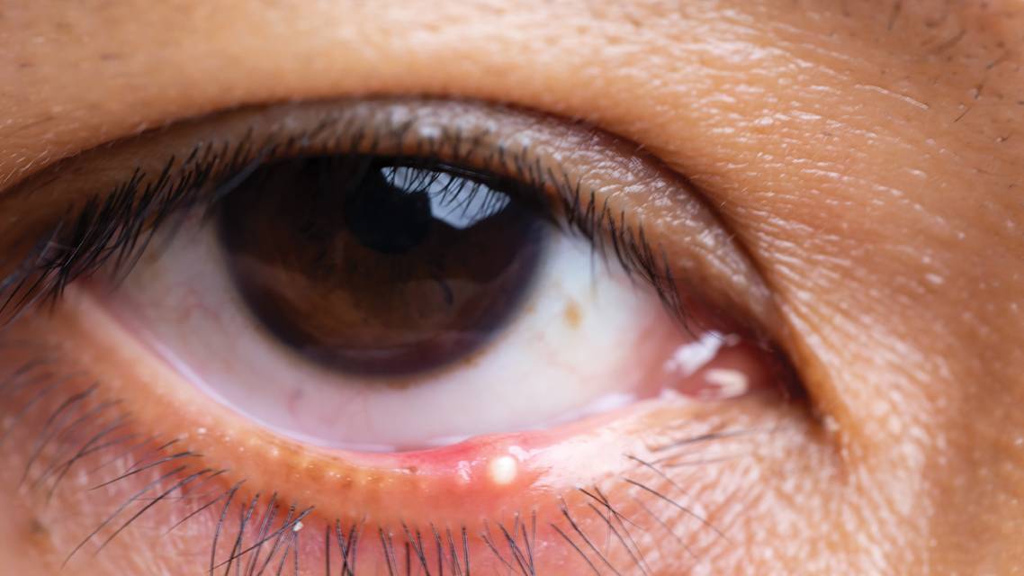 Understanding MGD Through the Lens of Sebaceous Gland Dysfunction