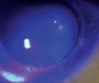 Recognizing and Managing Limbal Stem Cell Deficiency