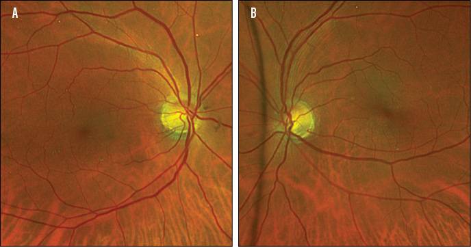 retina image