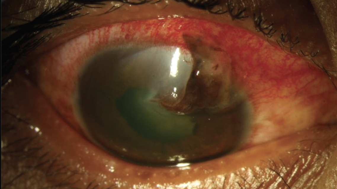 Optometrys Role in Open Globe Management