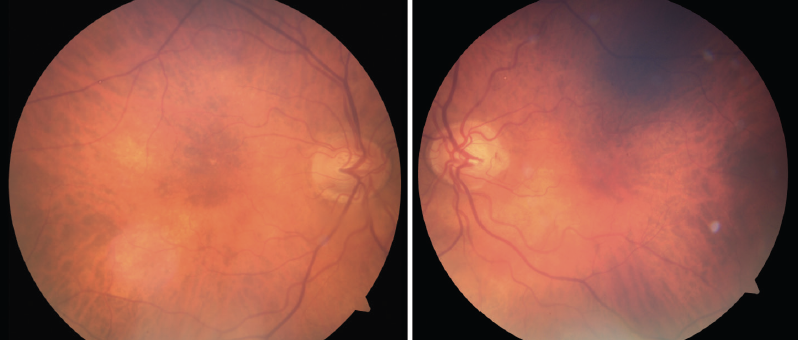 Glaucoma Diagnosis, Treatment, and Scope: a Review -