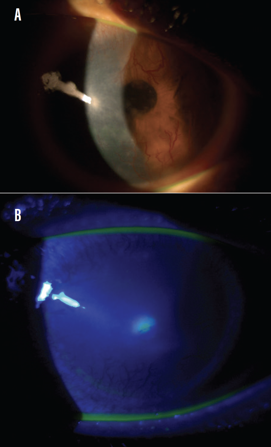 Posterior Float The Future of Eye Care Is … Prevention