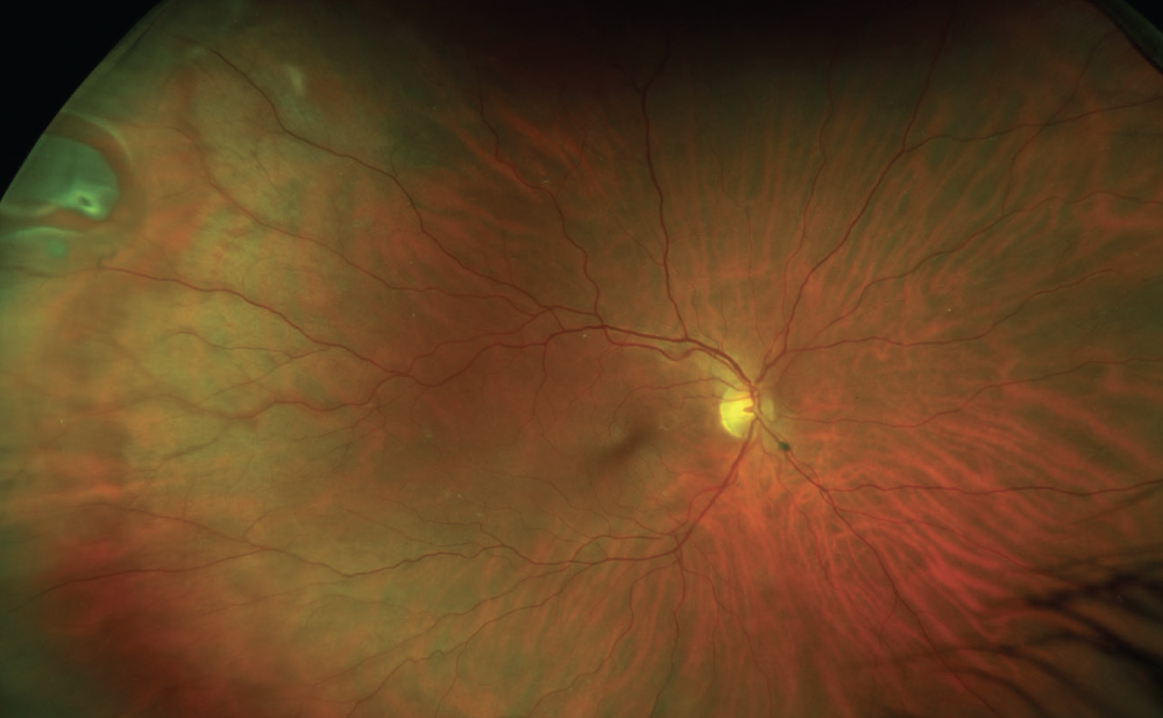 Beware the Floaters - Modern Optometry