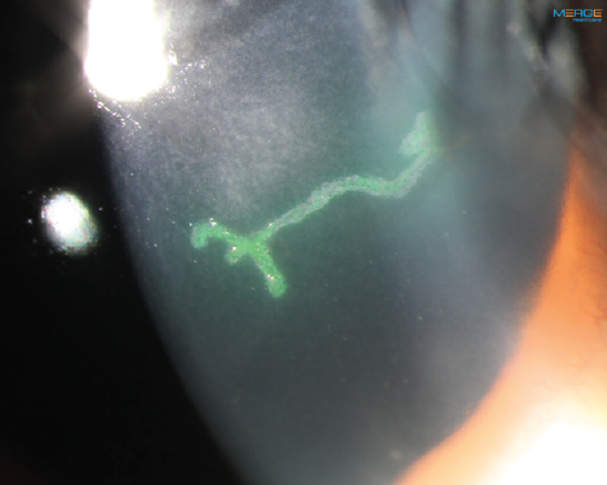 Unmasking Herpetic Eye Disease