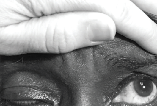 Levator Function Testing Ocular Ptosis and Its Differential Diagnosis