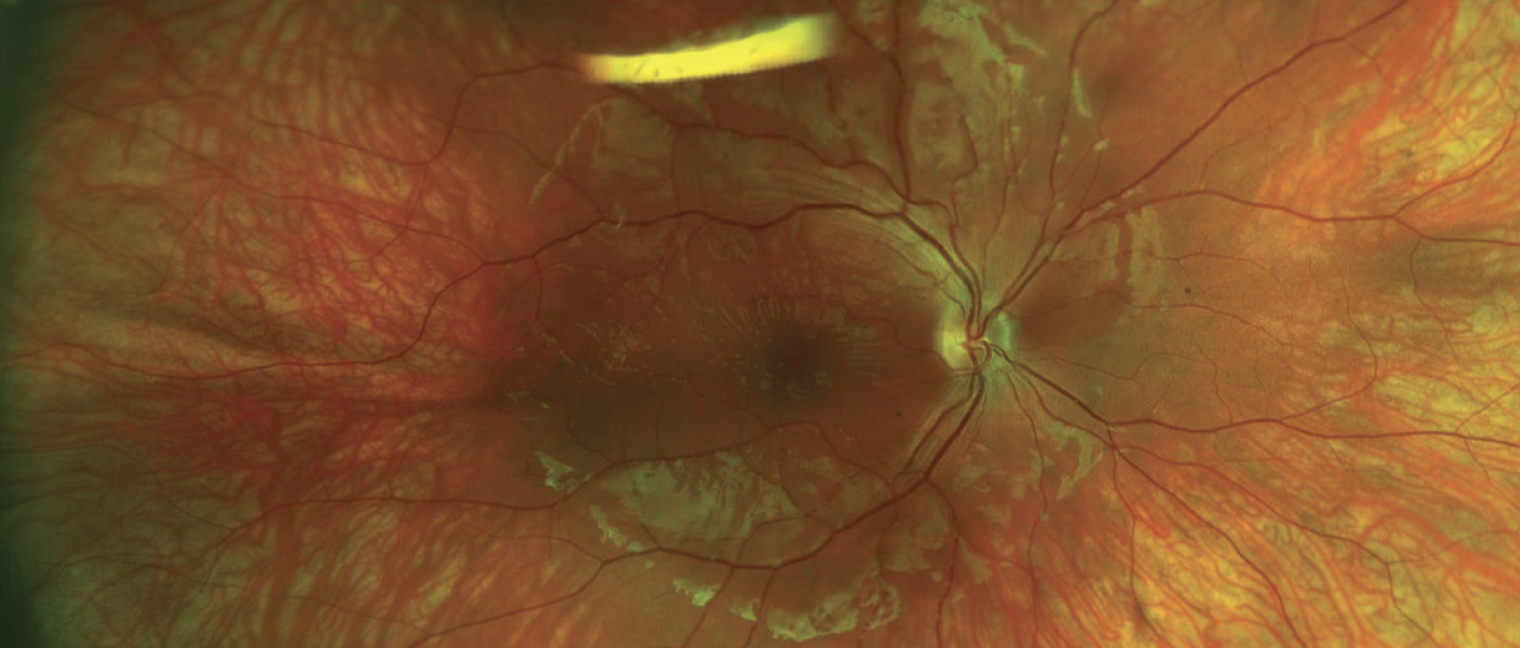 Retinal Splitting Lickety-Split Retina