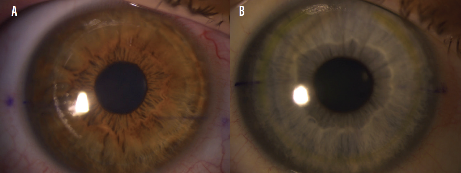 The Pros and Cons of LASIK vs SMILE