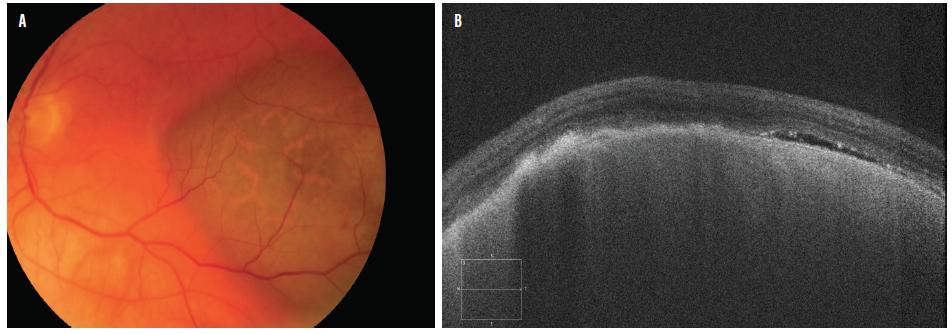 Photopsia Example Picture Cancer and the Posterior Pole
