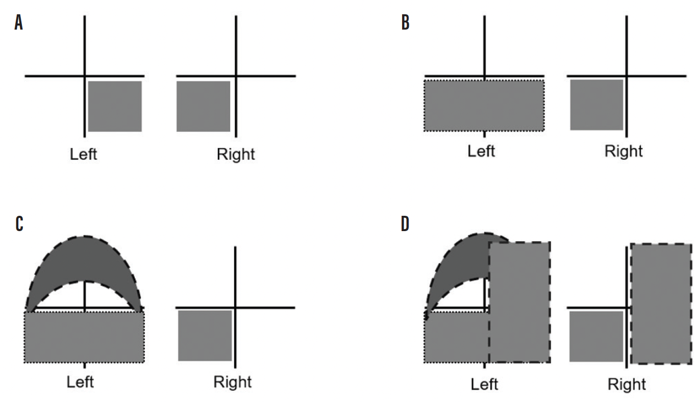 Left Visual A Case of Multiple Visual Field Defects Secondary to G...